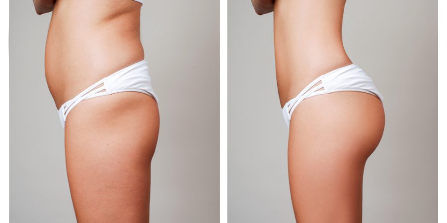 Fettsugning coolsculpting